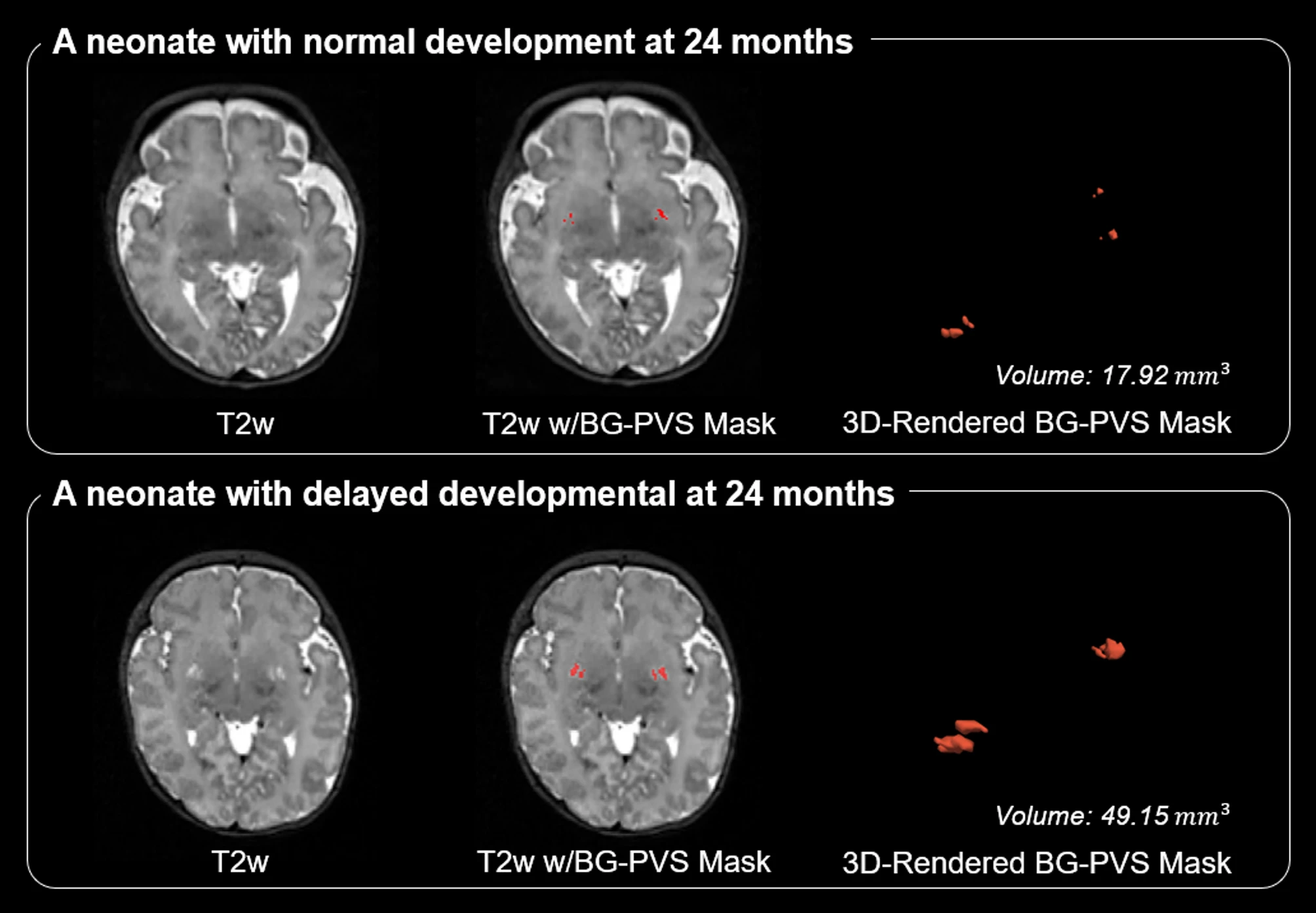 Infant LV and CP segmentation